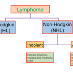 Dr Jay Datukan Talks About Lymphoma