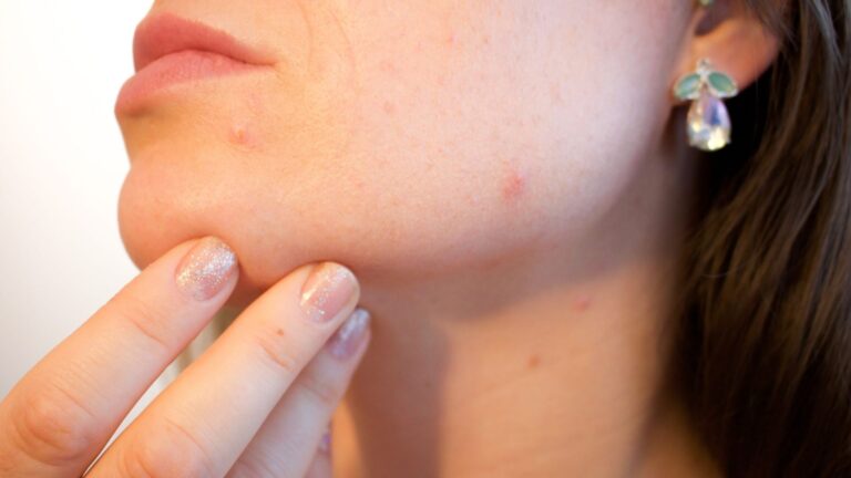Yes, adults can have acne too