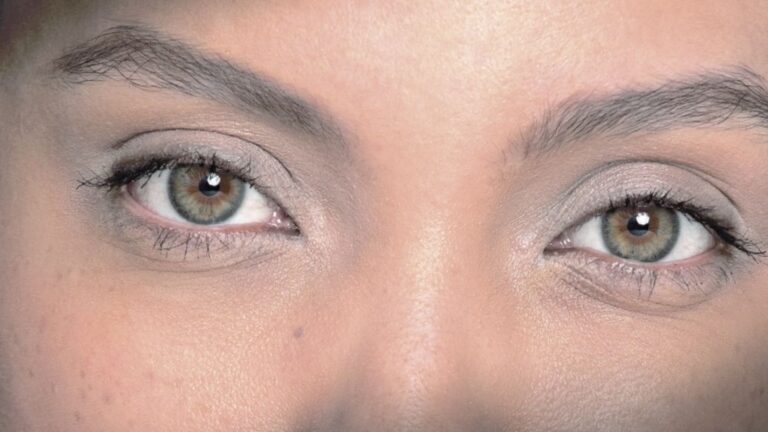 A New Look with Restylane ® Bright Eyes: