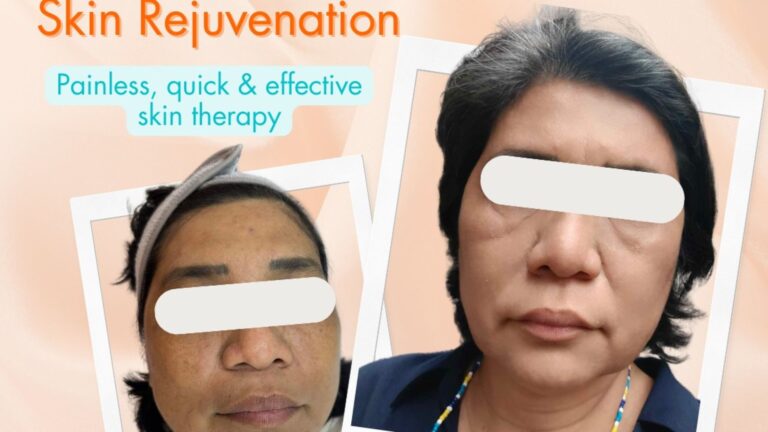 My Bio-Microneedling at RC Aesthetics & Wellness Clinic