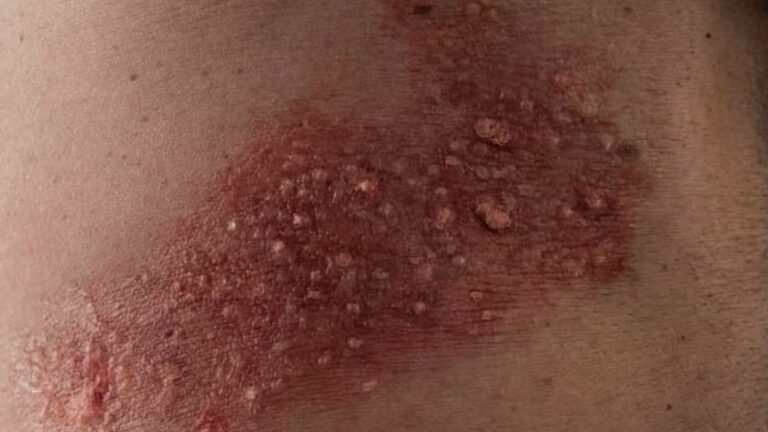 Shingles: The Reawakening of Chickenpox